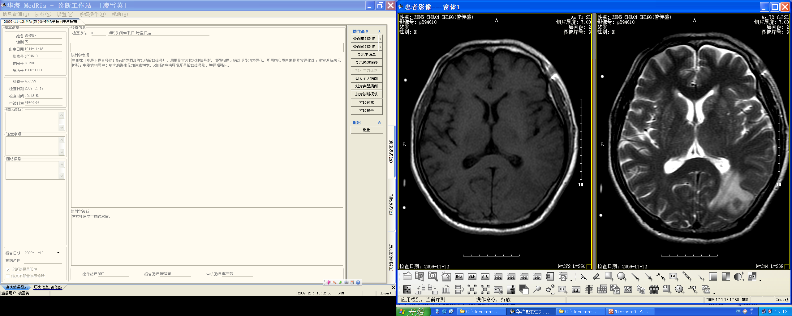 Brain metastases — gray-white junction, small nodule large edema