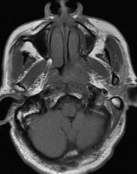 NPC — nasopharyngeal mass with skull base involvement