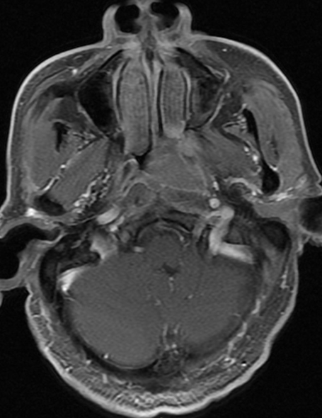 NPC — nasopharyngeal mass with skull base involvement