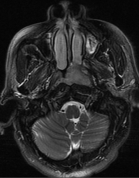 NPC — nasopharyngeal mass with skull base involvement