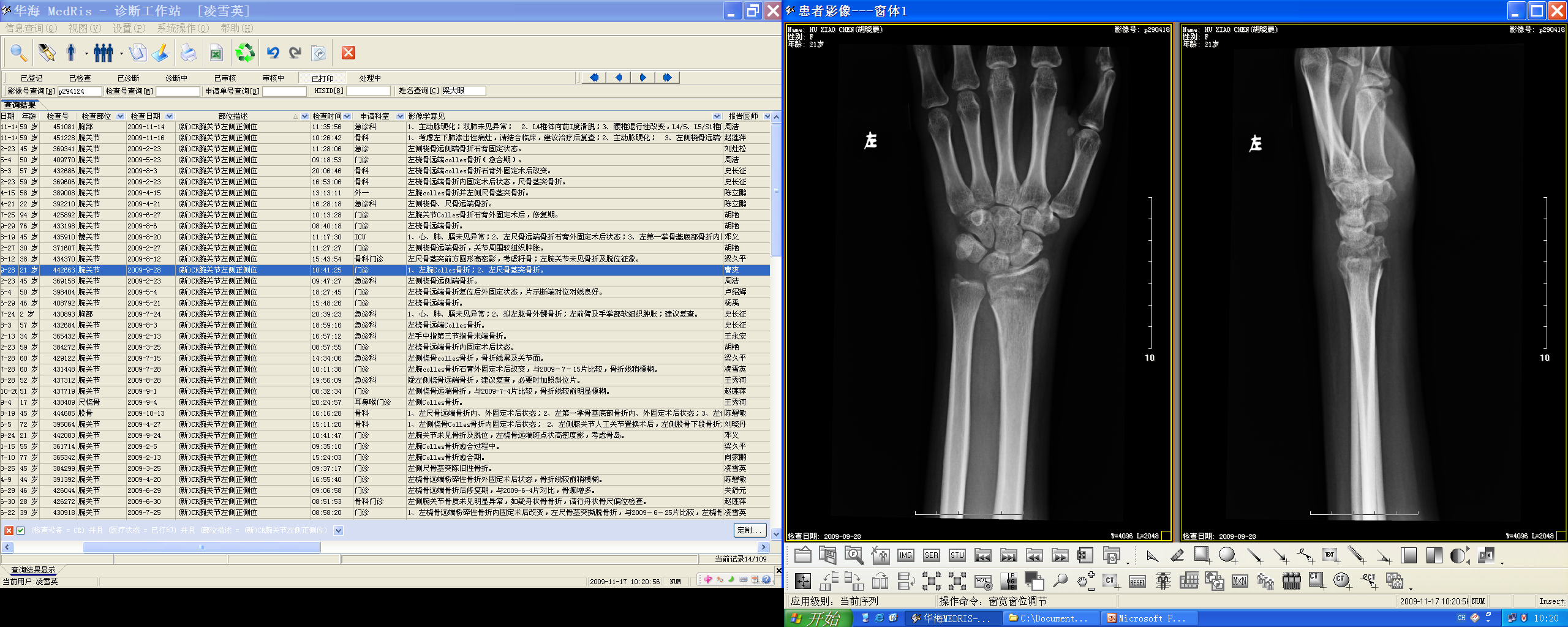 Colles' fracture — dinner-fork deformity