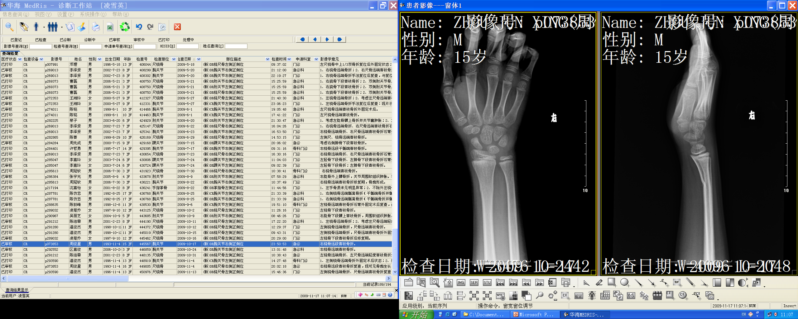 Greenstick fracture — incomplete fracture in a child
