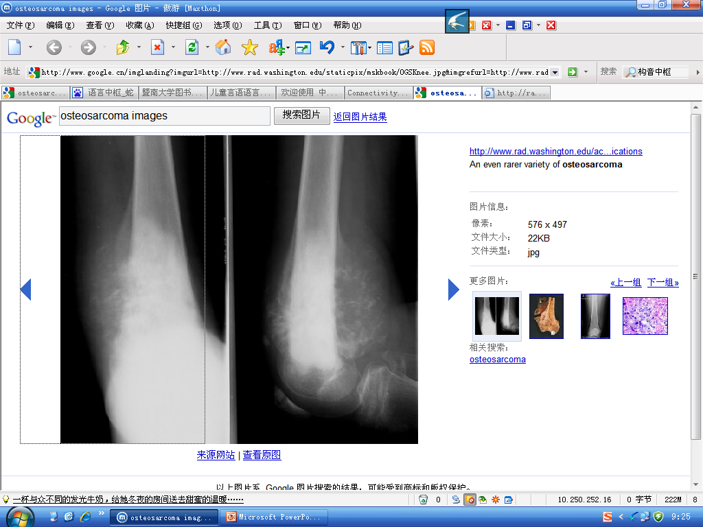 Osteosarcoma — sunray appearance, Codman's triangle