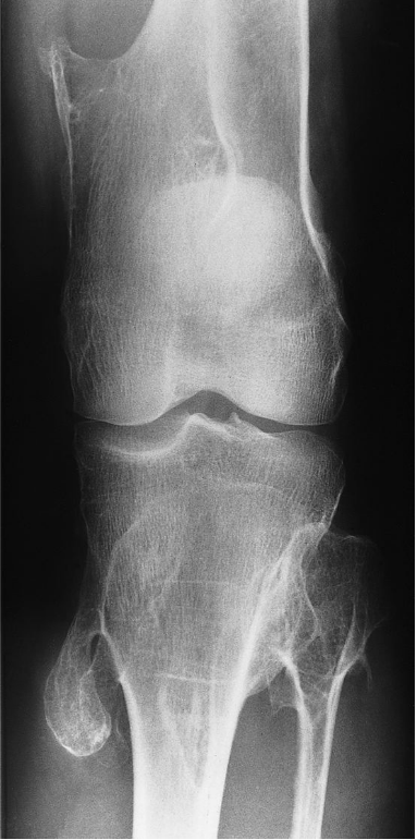 Osteochondroma — cartilage-capped exostosis