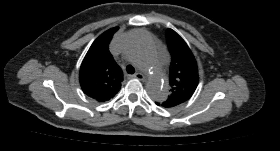 Aortic dissection — intimal flap, true/false lumen