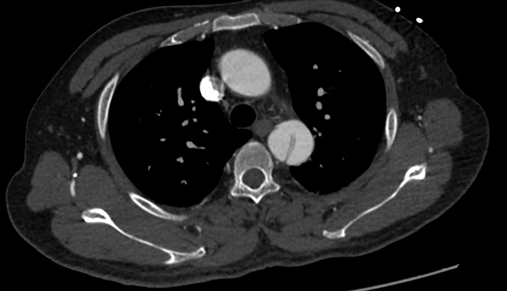 Aortic dissection — intimal flap, true/false lumen