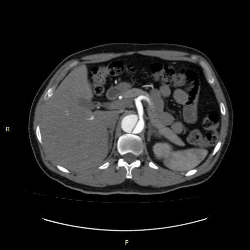 Aortic dissection — intimal flap, true/false lumen