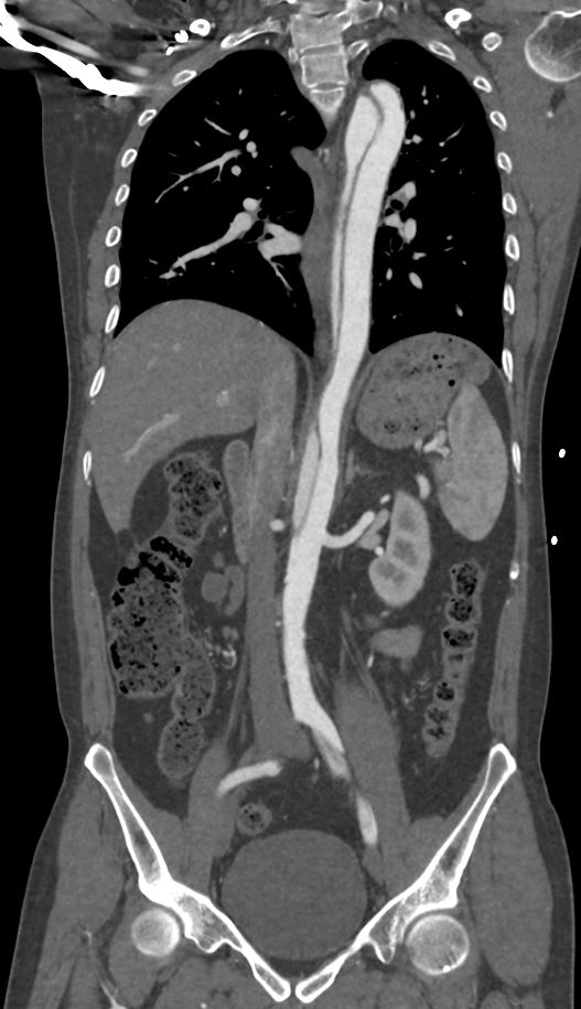 Aortic dissection — intimal flap, true/false lumen