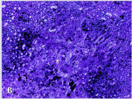 Histopathology of HFRS in renal medulla — well-defined necrotic lesion with surrounding haemorrhage; the pathognomonic kidney finding.