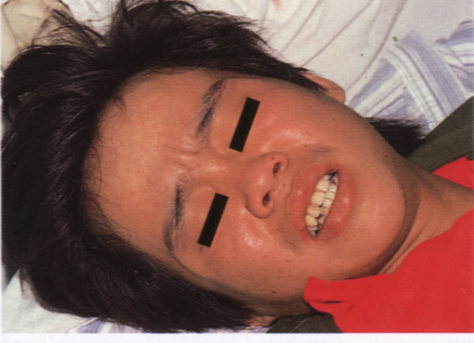 Facial petechiae and conjunctival involvement in dengue — warning sign for plasma leak.