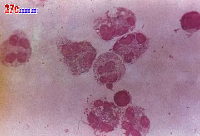 Brucella in blood — small Gram-negative coccobacillus within macrophages; characteristic intracellular location.