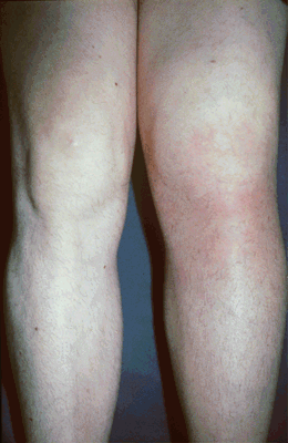 Sacroiliitis / peripheral arthritis — the most common focal complication of brucellosis.