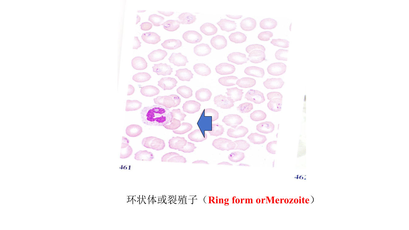 Plasmodium ring-form trophozoite (早期滋养体) inside a red blood cell — the classic malaria blood film finding.