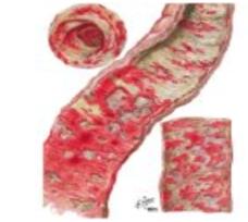 Colonic mucosa histology — fibrinopurulent exudate, neutrophil infiltration, surface epithelial necrosis in acute bacillary dysentery.