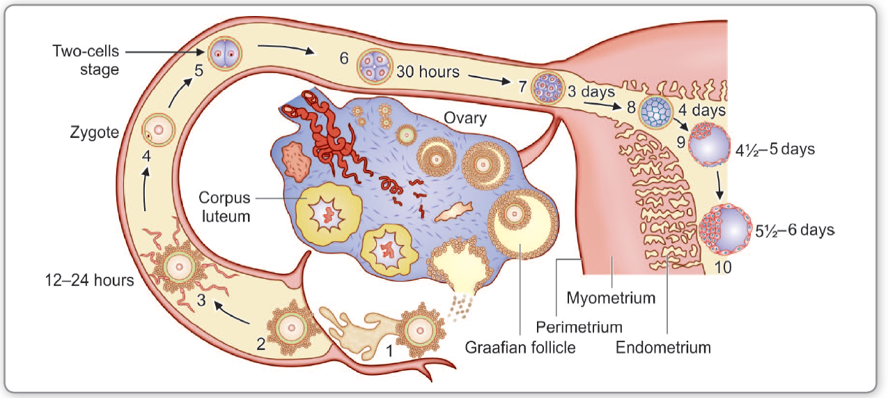 Ectopic pregnancy — fertilised ovum implanted outside the endometrial cavity, most often the fallopian tube (ampulla).