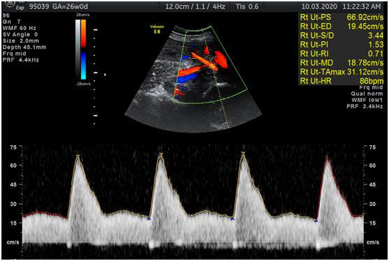 Preeclampsia pathogenesis — placental ischaemia → endothelial dysfunction → hypertension, proteinuria, and multi-organ involvement.