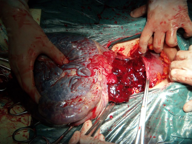 Placental abruption — retroplacental clot on USS; negative USS does not exclude abruption — diagnose clinically.