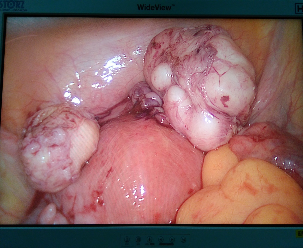 Uterine fibroid types — submucosal (heavy bleeding), intramural (most common), subserosal (pressure), pedunculated.