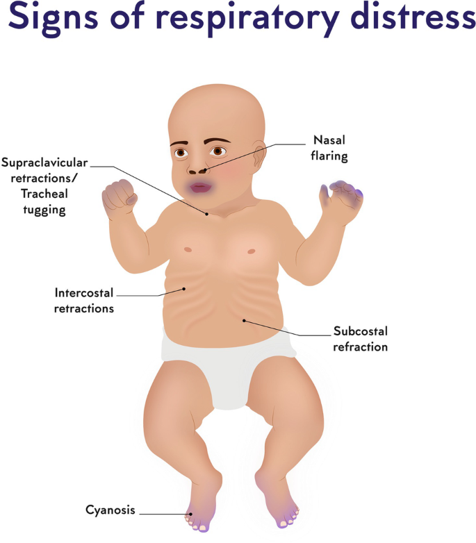 New Ballard score — assessment of gestational age in newborns by neuromuscular and physical maturity (used to confirm GA when dates unsure).