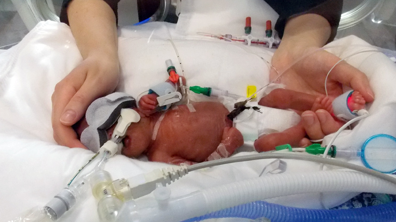 Preterm vs term infant — preterm features (translucent skin, lanugo, immature features) and the hazards of prematurity (RDS, NEC, IVH, ROP).