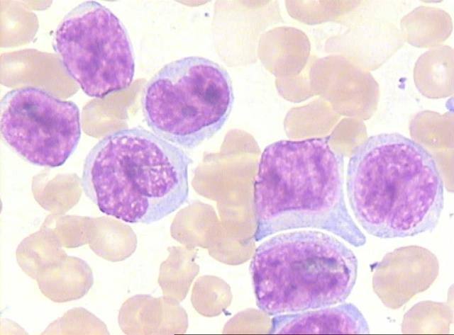 Acute leukaemia — peripheral blood film with blasts; pancytopenia + blasts → bone marrow aspirate is diagnostic (blast count >20-25%).