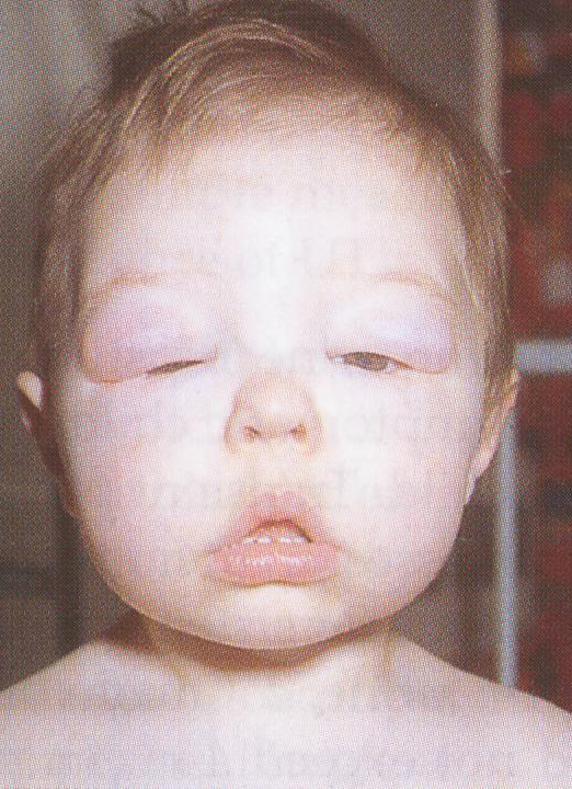 Nephrotic syndrome — heavy proteinuria + hypoalbuminaemia → oedema (periorbital first); complications: infection, thrombosis, steroid toxicity.